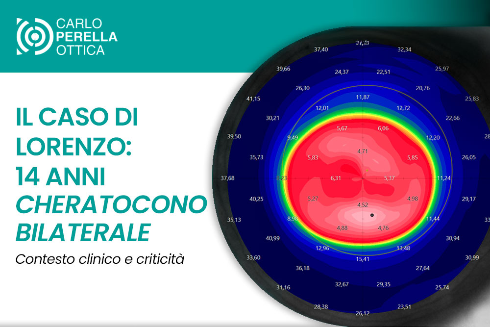 Il caso clinico di Lorenzo: recupero visivo con lenti sclerali in cheratocono avanzato